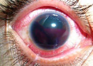 All about Conjunctivitis